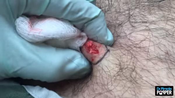 the jungle is dark but full of diamonds a dr pimple popper dpow 4 8 screenshot 1