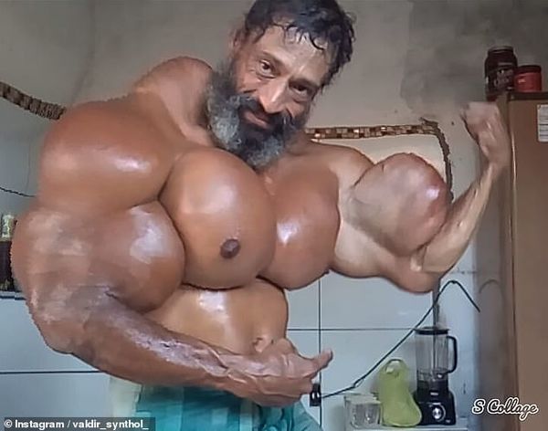 Ông chú Brazil liều mạng tiêm synthol để có cơ bắp 'khủng' như Hulk